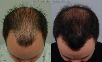 Top view before and after hair replacement procedure