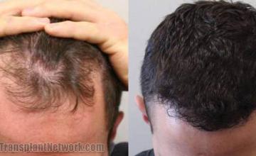 Before and after hair transplant procedure images