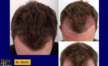 Top view before and after hair restoration results