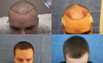 Before and after hair transplant procedure images