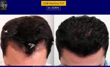 Hair transplantation surgery before and after photos