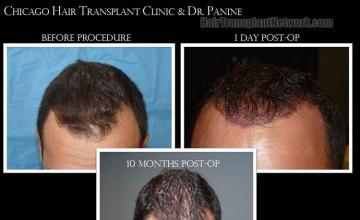 Hair transplantation surgery before and after photos