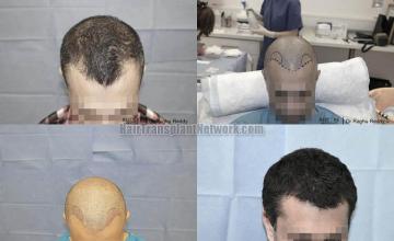 Hair transplantation surgery before and after photos