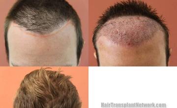 Hair transplantation surgery before and after photos