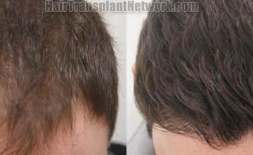 Hair transplantation surgery before and after photos