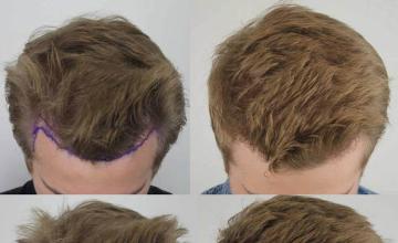 Hair transplantation surgery before and after photos