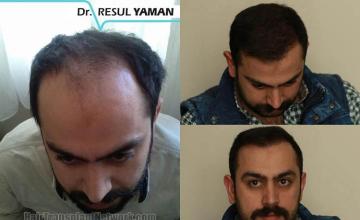 Hair transplantation surgery before and after photos