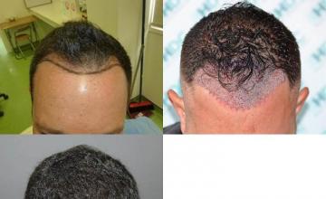 Hair transplantation surgery before and after photos