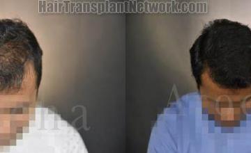 Before and after hair restoration procedure images