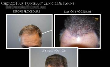 Before and after hair restoration procedure images