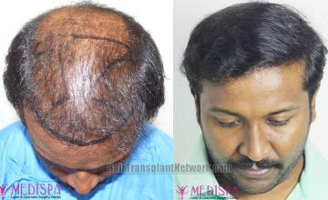 Hair restoration procedure before and after results