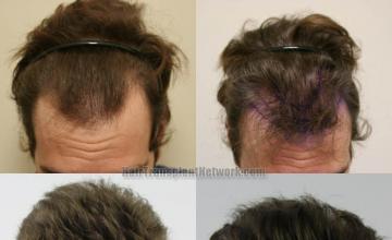 Before and after hair restoration procedure images