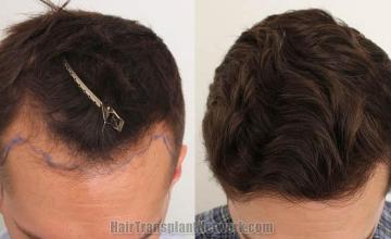 Hair transplantation surgery before and after images