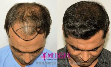 Before and after hair restoration procedure images