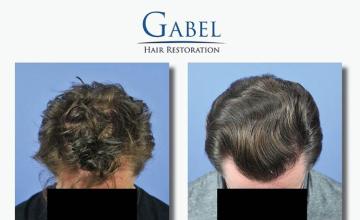 Before and after hair restoration procedure images