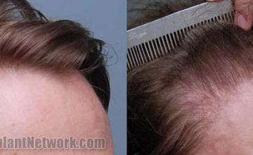 Before and after hair transplant procedure images