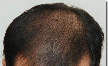 Hair restoration procedure results