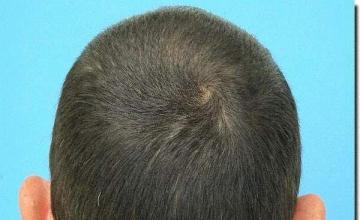 Hair restoration procedure results