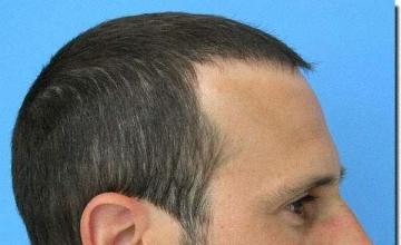 Hair restoration procedure results