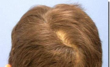 Hair restoration procedure results