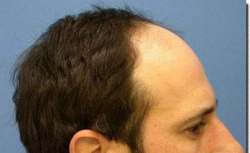 Hair restoration procedure results