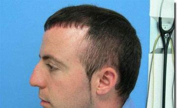 Hair restoration procedure results