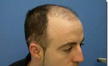 Hair restoration procedure results