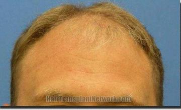 Hair restoration procedure results