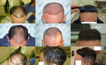  before and after photos