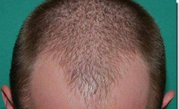 Hair restoration procedure results