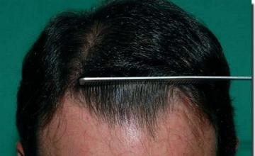 Hair restoration procedure results