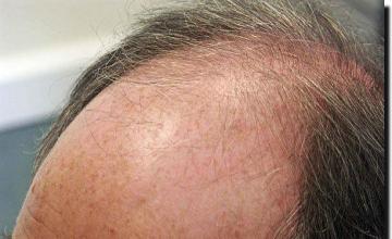 Hair restoration procedure results