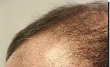 Hair restoration procedure results