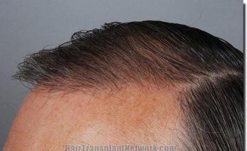 Hair restoration procedure results