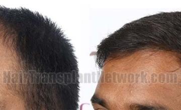 Left view before and after hair transplant surgery