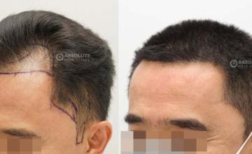 Left view before and after hair transplant surgery