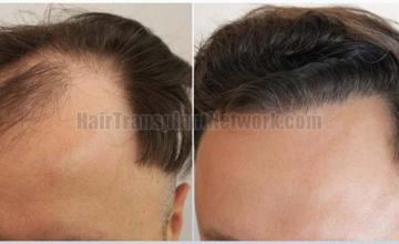 Left view before and after hair transplant surgery