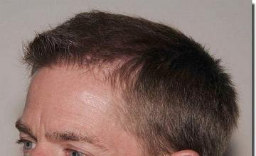 Hair restoration procedure results