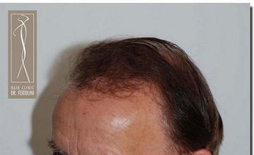 Hair restoration procedure results