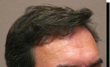 Hair restoration procedure results