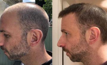 Left view before and after hair transplant surgery