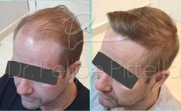 Left view before and after hair transplant surgery