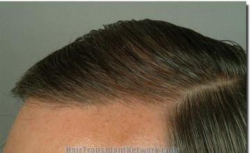 Hair restoration procedure results