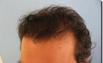 Hair restoration procedure results