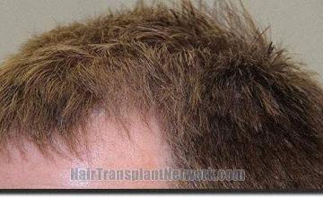 Hair restoration procedure results