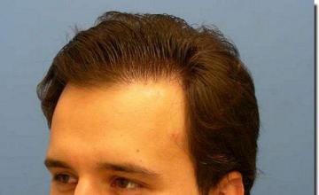 Hair restoration procedure results