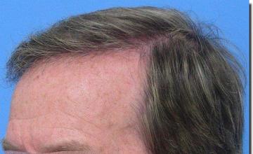 Hair restoration procedure results