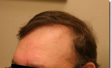 Hair restoration procedure results