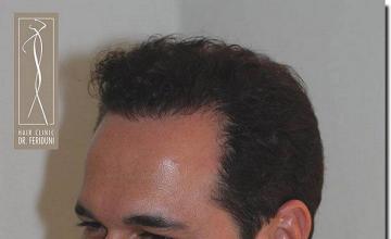 Hair restoration procedure results