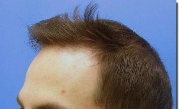 Hair restoration procedure results